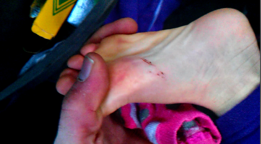 Here is the cut about one week after Karen De La Cruz and Rosemary Wilkkomm claim they inspected the foot and saw no cut.